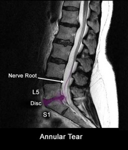 Herniated L5-S1 Disk